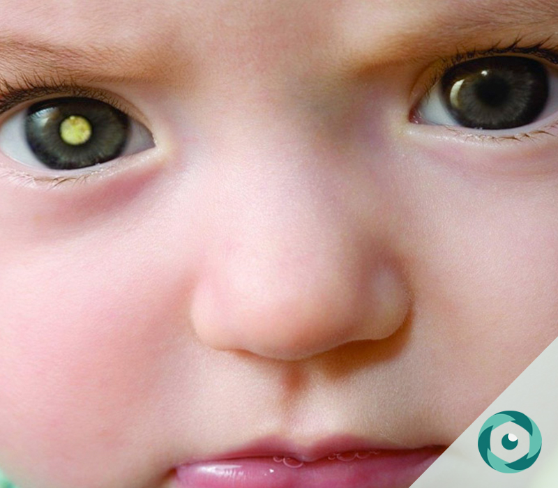 Comemora-se neste dia 18 de Setembro o Dia da Detecção Precoce do Retinoblastoma